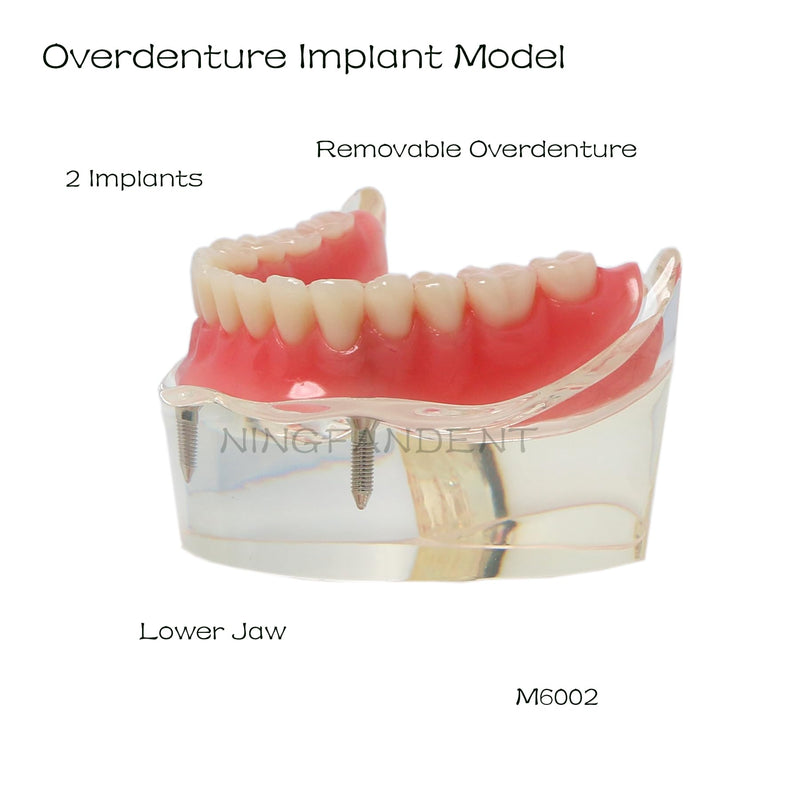 Dental Implant Model, Lower Jaw Overdenture, Removable Overdenture, with 2 Implants,M6002 M602
