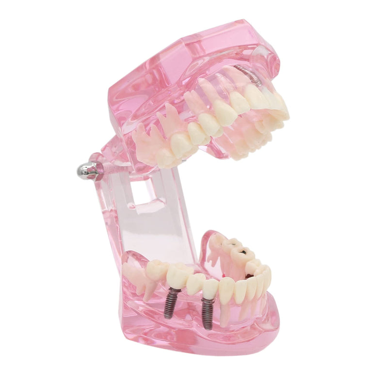 Teeth Model Teeth Typodonts Dental Implant Study Analysis Demonstration Teeth Model #2001 with Restoration Pink - BeesActive Australia