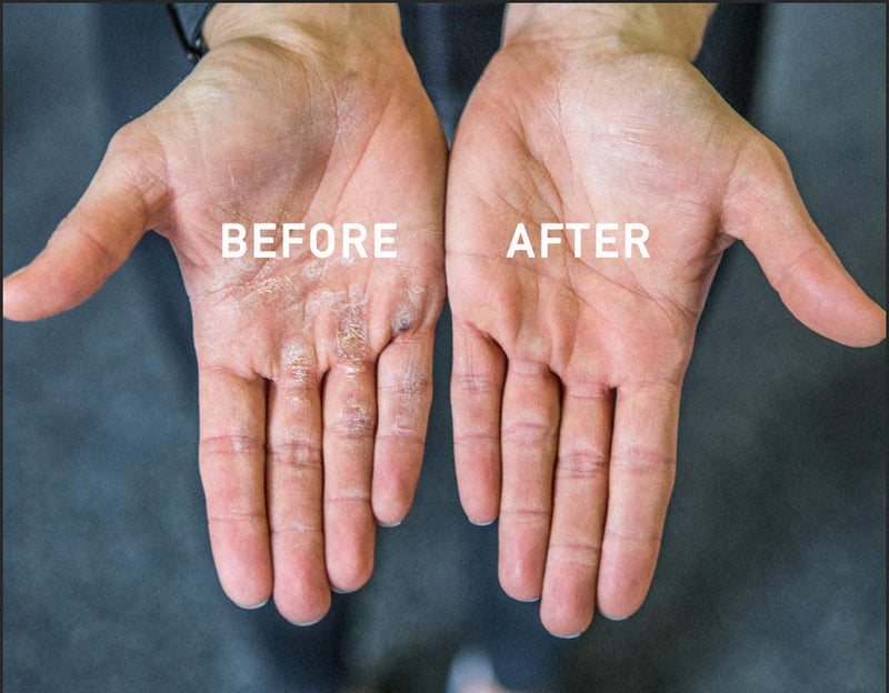 Callus Rx (Formerly BLOQAID) Callus Removal Tool | Eliminates Hard Palm Skin | No Pumice Stone or Gloves | Removes Calluses in Seconds | Best Hand Callus Remover for Workouts, WODs, Weightlifting
