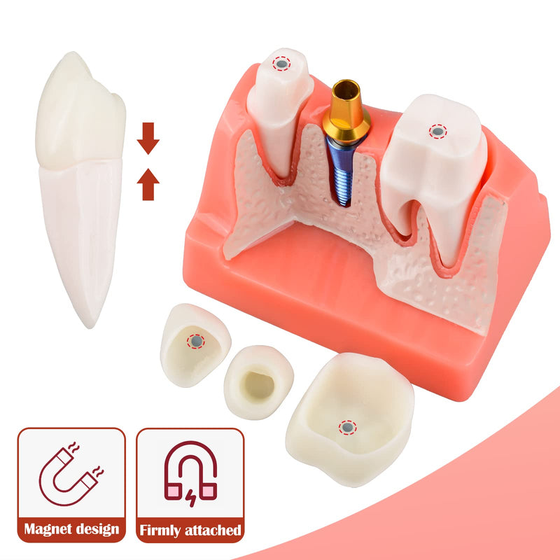 Ultrassist 4 Times Dental Implant Model for Patient Education Pink