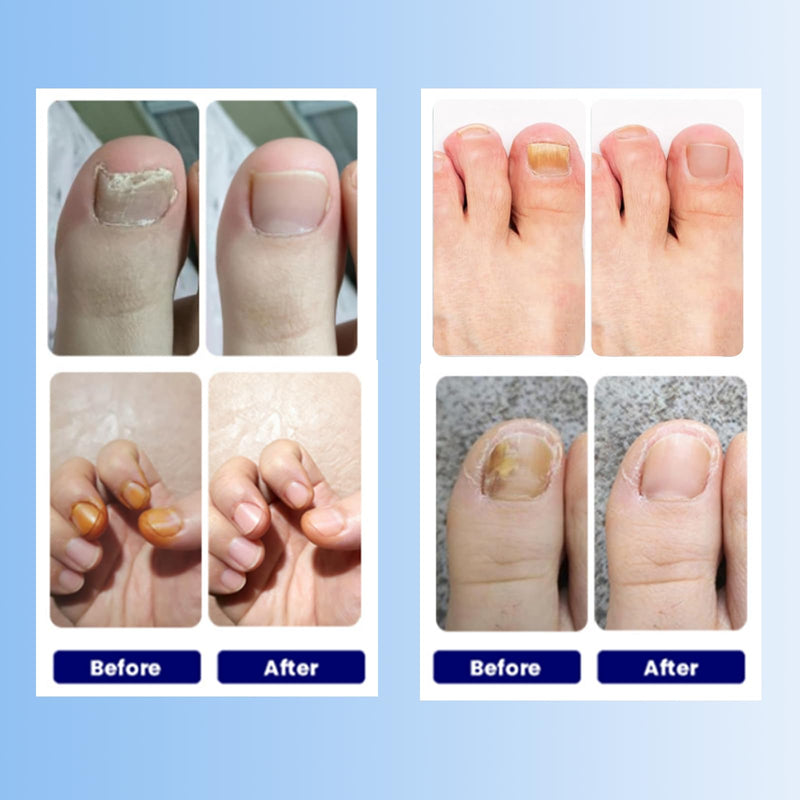 Toenail Fungus Treatment Extra Strength - 21 Pcs Fungal Nail Patches, Foot Nails Repair & Strengthen Patches for Women & Men (1 Count (Pack of 21)) 1.76 Ounce (Pack of 1) - BeesActive Australia
