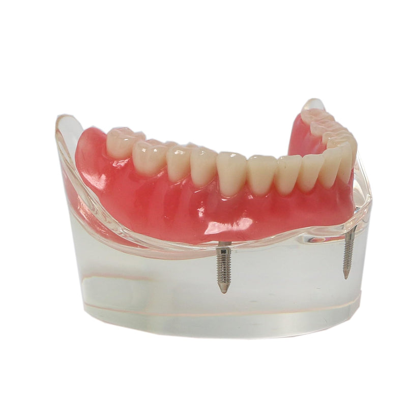Dental Implant Model, Lower Jaw Overdenture, Removable Overdenture, with 2 Implants,M6002 M602