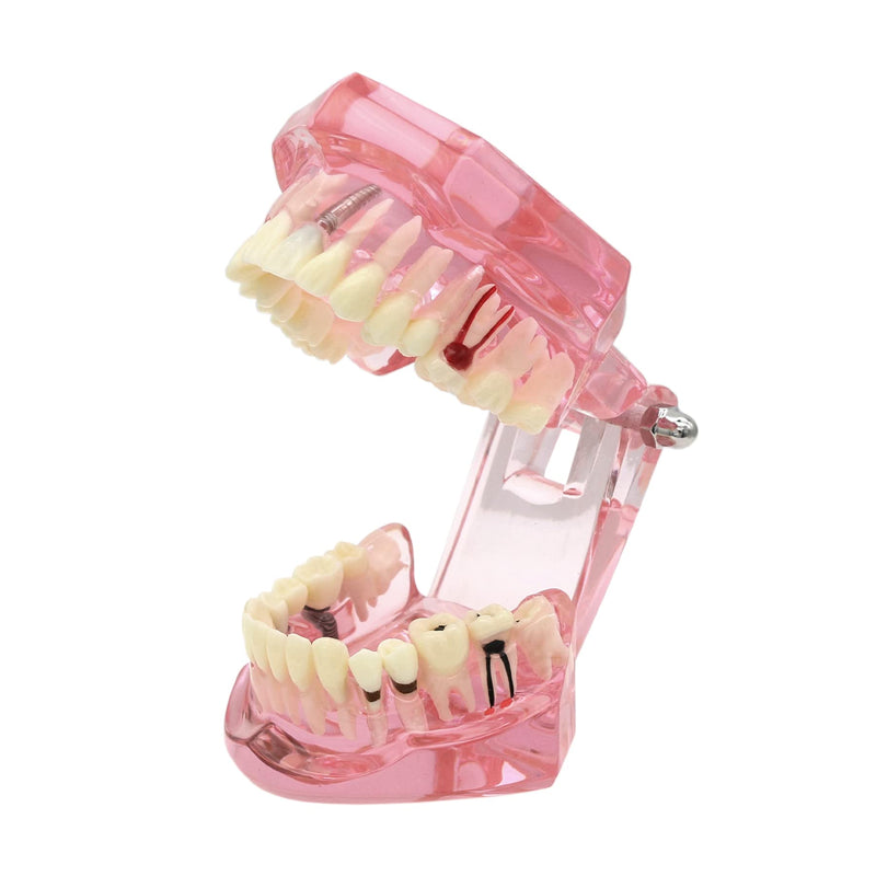 Teeth Model Teeth Typodonts Dental Implant Study Analysis Demonstration Teeth Model #2001 with Restoration Pink - BeesActive Australia