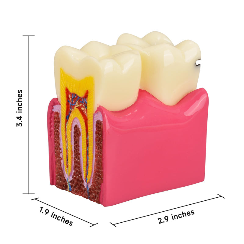 Ultrassist Dental Tooth Decay Model, Dental Caries Demonstration Model, Tooth Anatomy Teaching Model for Dental Education, Patient Explanation and Oral Health Classroom Teaching - BeesActive Australia