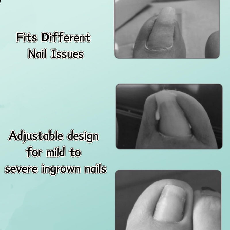 Ingrown Toenail Corrector Kit for Men Women - Ingrown Nail Tool - 2 Stainless Steel Clips- Curved Nail Strips & Toe Pads for Embedded/Curled Nails