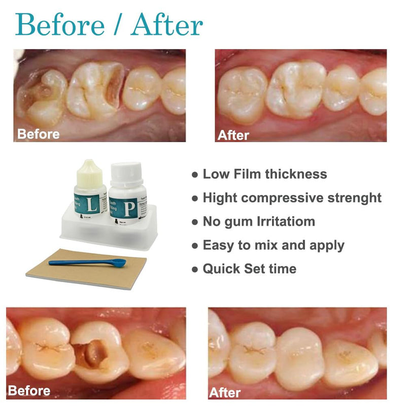 Zinc Oxide Eugenol Dental Cement Kit | Super Adhesive | Instant Tooth Repair, Cap, Crown & Bridge Filling | DIY, Self Curing, Sturdy & High Strength |Universal Shade| Emergency Dental Care |