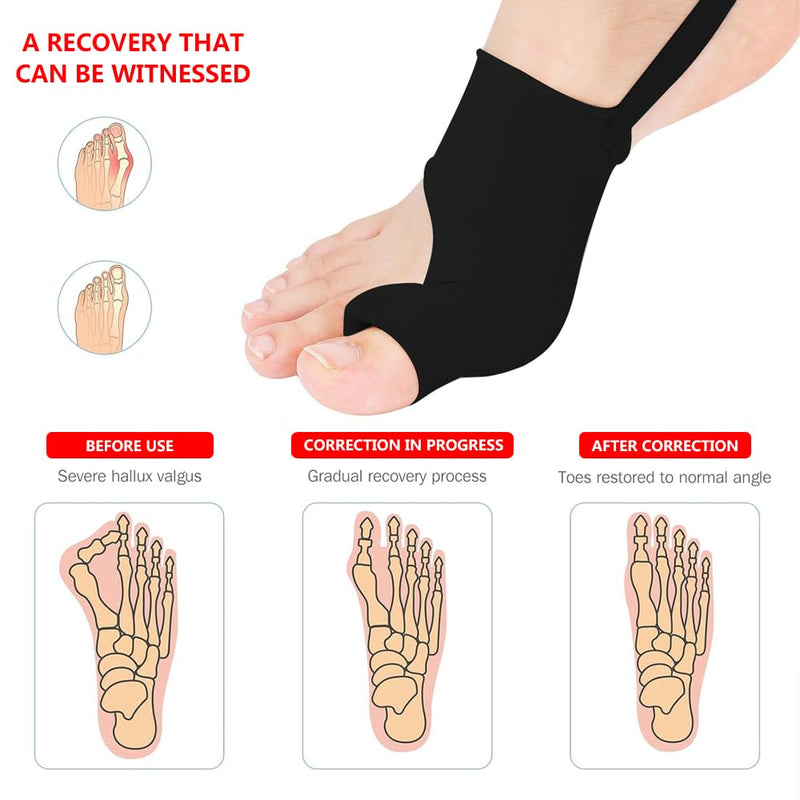 2PCS Bunion Corrector for Women & Men,Big Toe Separators-Bunion Splint-Bunion Pads-Hammer Toes Straightener-Toes Spacers Pain Relief, Comfortable & Breathable for Day/Night Black - BeesActive Australia