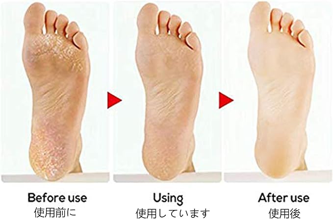 UNG Exfoliating Heel Exfoliating Heel Care, Exfoliating Double-sided, Heel File, Professional Stainless Steel Foot File, For Pedicure, Double-Sided File For Pedicure, Fish Sharpener, Foot, Heel Sharpener (Blue) - BeesActive Australia