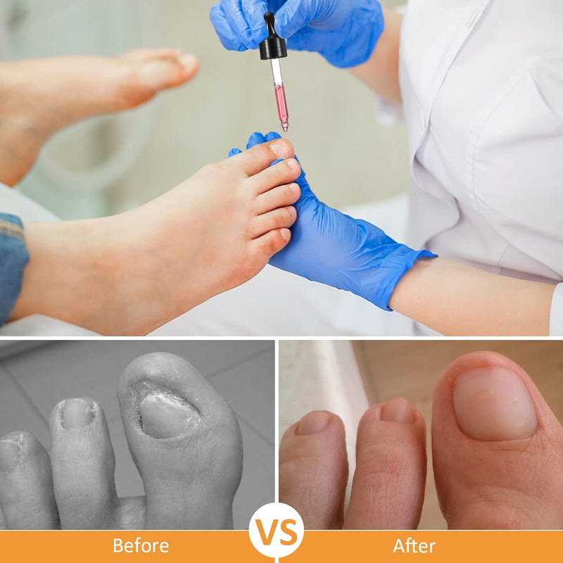Treatonic Ingrown Toenail Treatment Drops - Ingrown Toenail Softener and Reliever Kit for Easy Trimming with Silicone Gel Toe Caps - 2 Pack Ingrown Toenail Drops - 2 Pack - BeesActive Australia