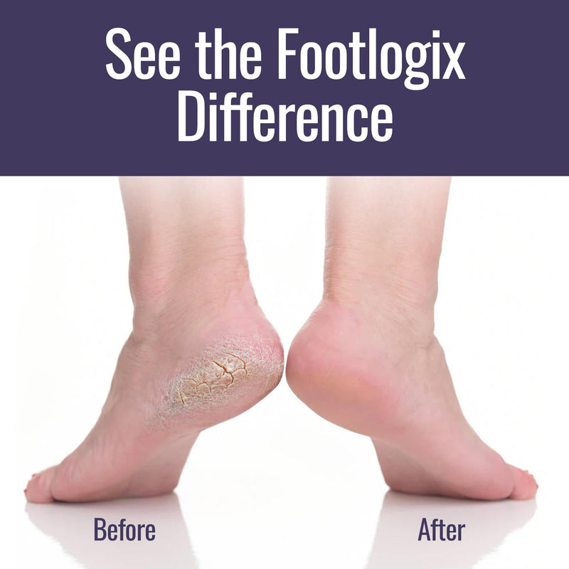 Footlogix Foot Care Callus Softener Combo - Callus Remover Spray & Double-Sided Foot File for Dry, Cracked Heels, Pedicure Tools for Feet, Foot Exfoliator White