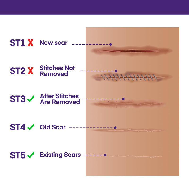 Silicone Scar Gel Scar Cream: SPF 30 Advanced Medical-Grade Formula for Surgical Scars, C-Section, Stretch Marks, Acne, Burns, Keloids, Old & New Scars – Broad Spectrum UV Protection 1.06oz (30g) - BeesActive Australia
