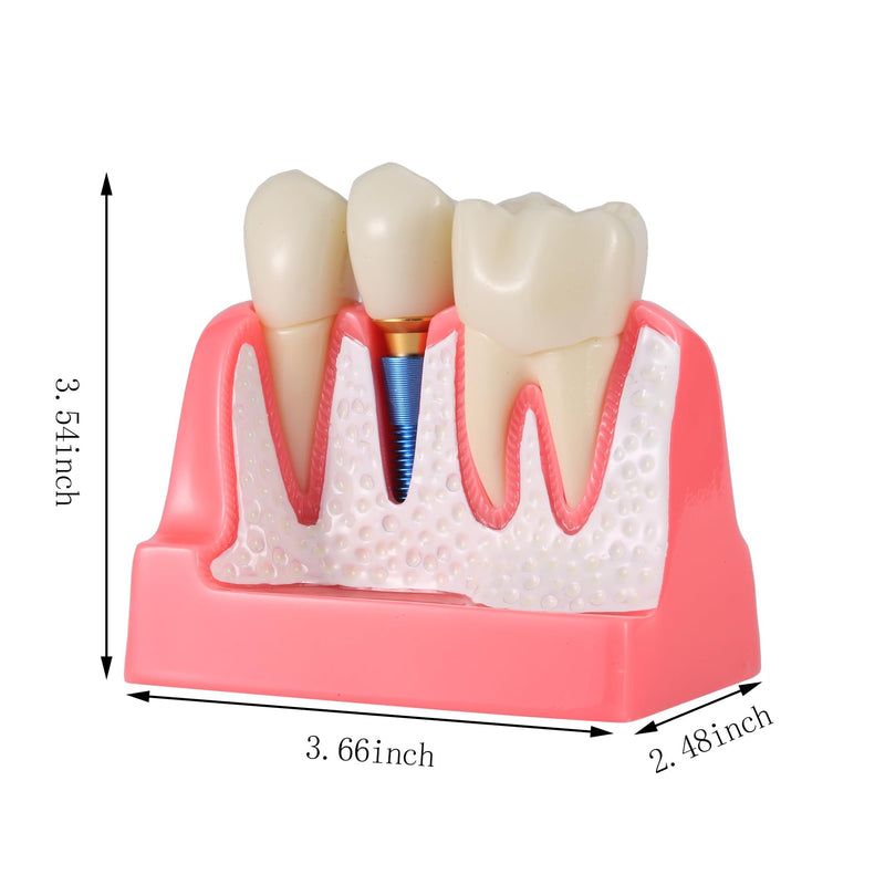 4X Dental Implant Demo Model