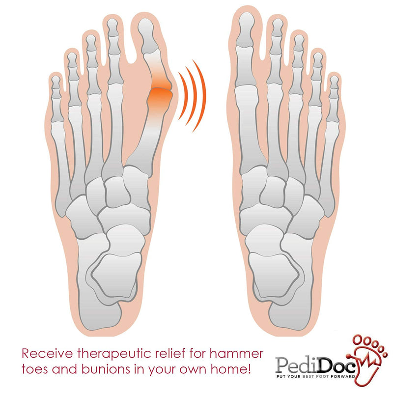 Bunion Corrector Bunion Toe Straightener – Bunion Relief Big Toe Strap Bunion Splint Restores Natural Alignment of Overlapping and Crooked Toes – Big Toe Spacer and Toe Stretcher
