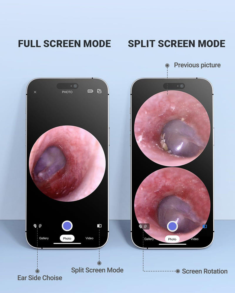 Wireless Otoscope with Gyroscope, Ear Camera with Dual View, 3.9 mm Otoscope with Light, Ear Scope with Ear Wax Removal Tool for Kids, Adults, and Pets, Compatible with iPhone and Android - BeesActive Australia