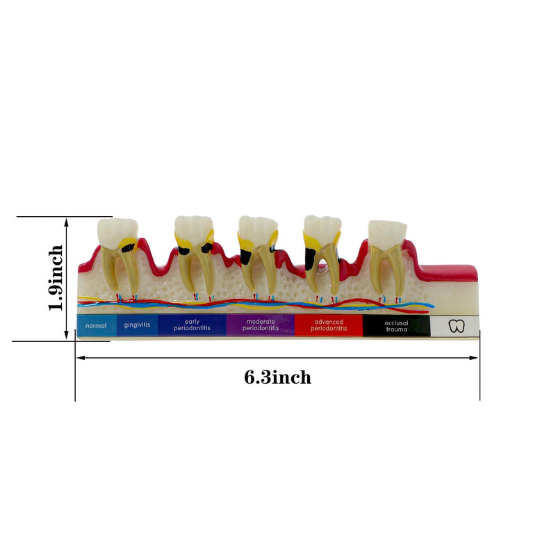 Dental Teeth Model 6-Stage Periodontal Disease Demonstration Model for Dental Education - BeesActive Australia