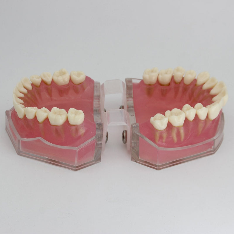 Dental Implant Teeth Model with Removable Teeth for Dental Professionals and Students - BeesActive Australia