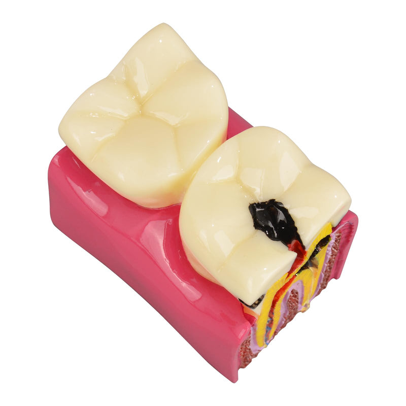 Ultrassist Dental Tooth Decay Model, Dental Caries Demonstration Model, Tooth Anatomy Teaching Model for Dental Education, Patient Explanation and Oral Health Classroom Teaching - BeesActive Australia
