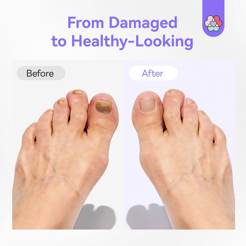 SAVILAND Toenail Fungus Pen Extra Strength: 2X Extreme Nail Repair 25% Undecylenic Acid 1% Tolnaftate Nail Fungus Pen for Damaged Yellow Discolored Thick Foot Toe Nails Softener Treatment Solution - BeesActive Australia