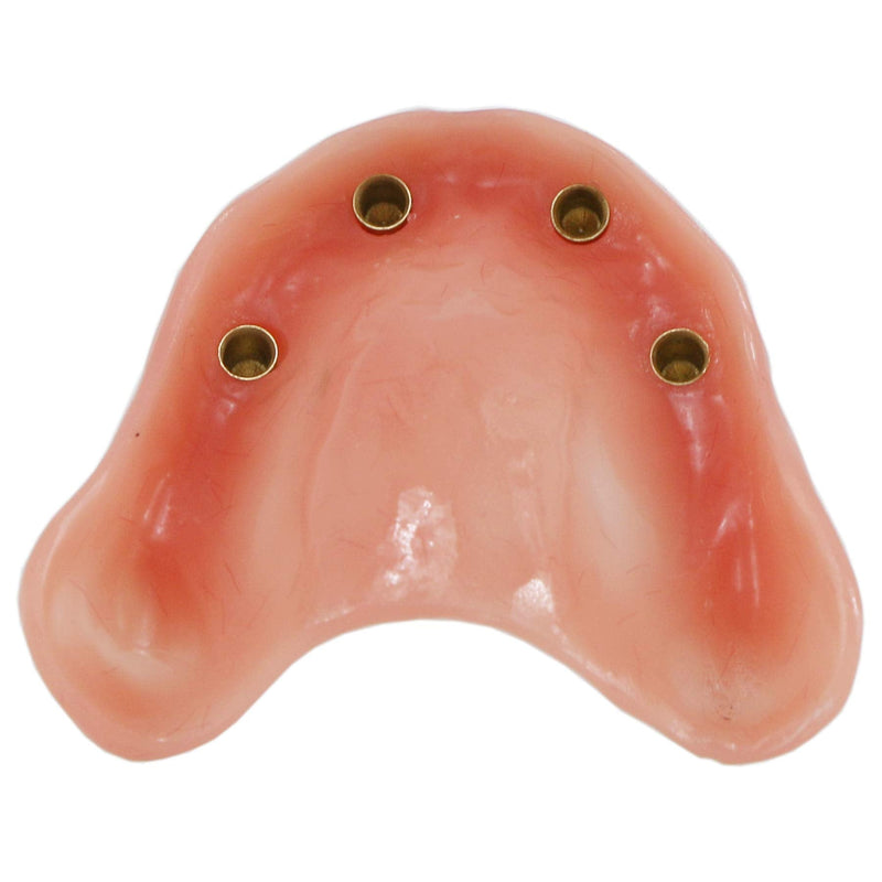 Dental Upper Implants Model Overdenture with 4 Superior Teeth Demo Transparent Vision for Education and Study Model Tool M6001 C