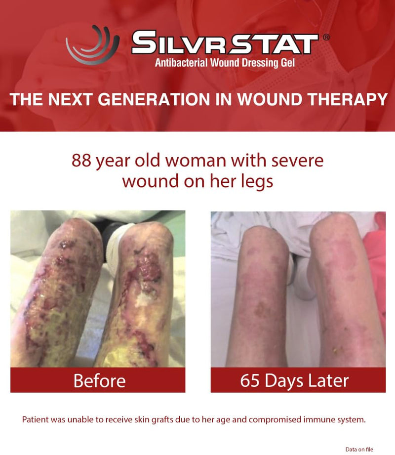 SilvrSTAT First Aid Kit Gel, 32 PPM Silver Healing Wound Dressing Gel, SilverSol Ag₄O₄ Particles, 1 oz 1 Ounce