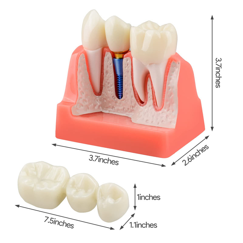 Ultrassist 4 Times Dental Implant Model for Patient Education Pink