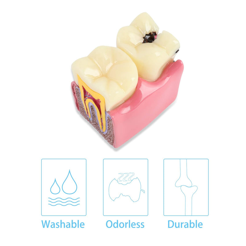 Dental Caries Tooth Model 6 Times Decay Teeth Comparative Study Model, Caries Bilateral Comparison Pathology Teeth Model Teaching Learning Tools for Dentist, Patient Education and Explanation - BeesActive Australia