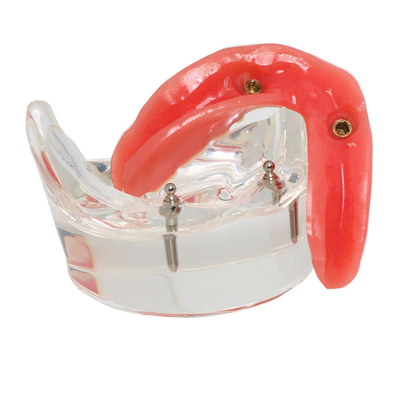Dental Implant Model, Lower Jaw Overdenture, Removable Overdenture, with 2 Implants,M6002 M602