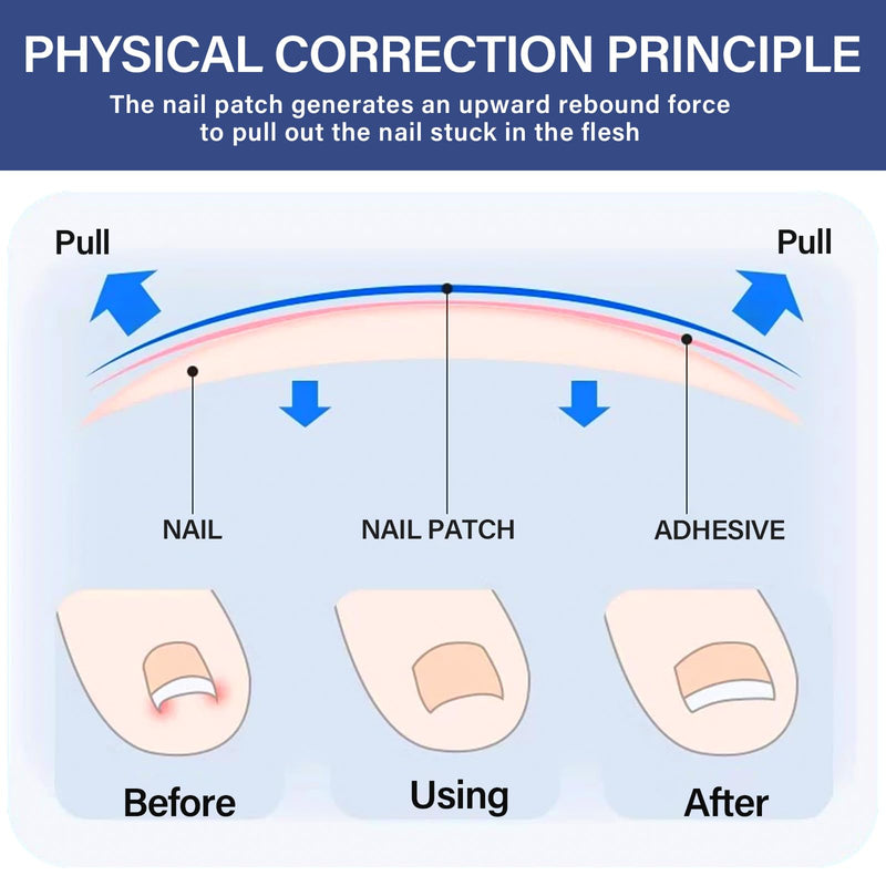 Ingrown Toenail Treatment-Patch(10pcs), Ingrown Toenail Corrector(Titanium Alloy), Ingrown Toenail Removal Kit, Cuttable Applicable for Any Nail Size, Nail Repair for Finger and Foot, Reusable Blue