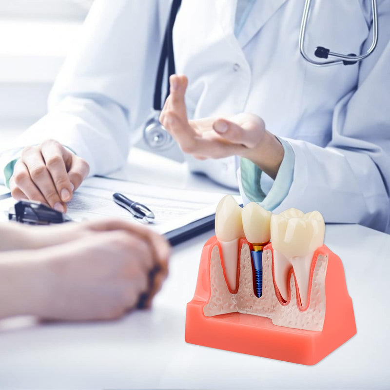 Ultrassist 4 Times Dental Implant Model for Patient Education Pink