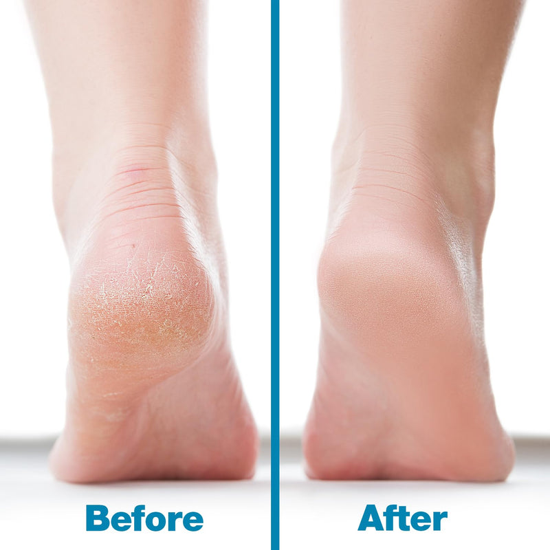 Probelle Double Sided Multidirectional Nickel Foot File Callus Remover - Immediately Reduces calluses and Corns to Powder for Instant Results, Safe Tool (Blue) Blue - BeesActive Australia