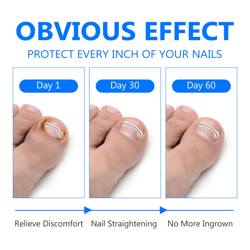 Ingrown Toenail Treatment, Toenail Correction Strips for Curved or Ingrown Nails, Quick Relief, Nail Correction, 5 Different Sizes 1 Count (Pack of 1)