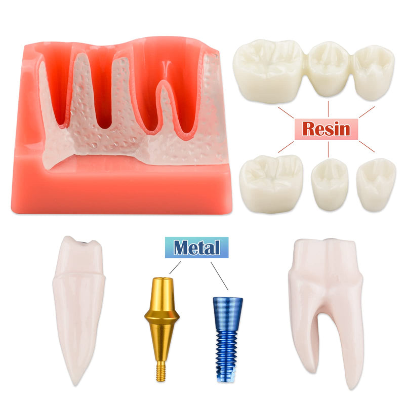 Ultrassist 4 Times Dental Implant Model for Patient Education Pink
