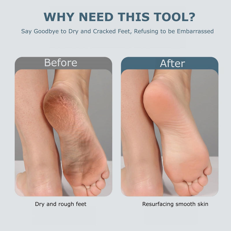Upgraded Electric Foot Callues Remover, Portable Electric Foot Files with 3 Heads, Rechargeable Feet File for Foot Care, Waterproof Deadskin Remover, Pedicure Tool for Dry and Crack Feet - BeesActive Australia