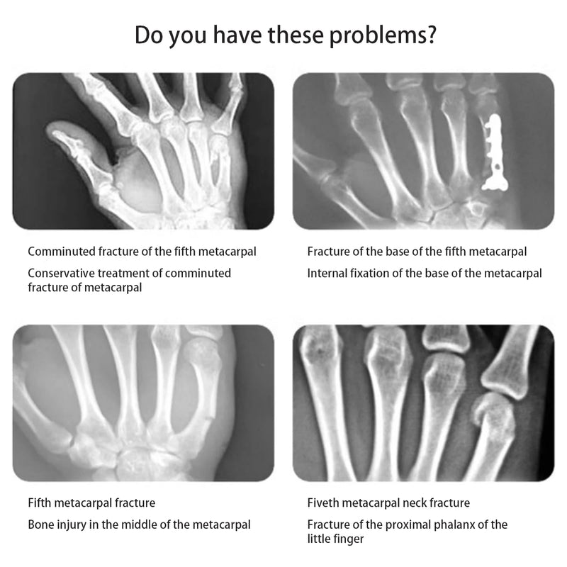 Pinky & Ring Finger Splint Brace - Left Hand Brace Support for Boxer Fracture, Mallet Finger & Dislocation, Arthritis, Sprain, Broken, Little Finger Cast Immobilizer Straightener (4th/5th Metacarpal) Medium Left Black 1