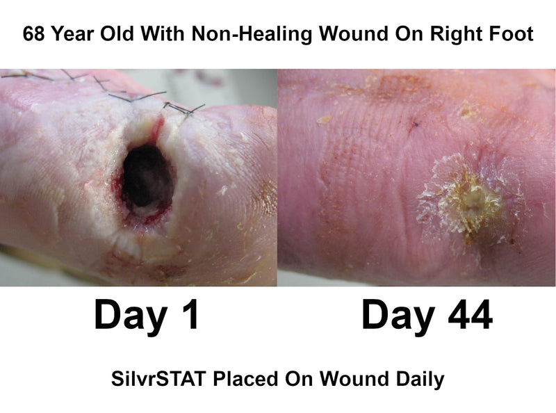 SilvrSTAT First Aid Kit Gel, 32 PPM Silver Healing Wound Dressing Gel, SilverSol Ag₄O₄ Particles, 1 oz 1 Ounce