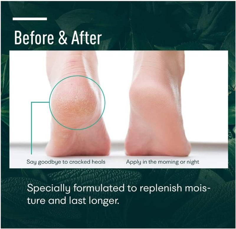 Urea cream 40 perent for feet: Maximum Strength Urea lotion -For Callus and Cracked Heels Treatment-Rough Thick Skin for foot- Crema 5.29 oz.(150g) 5.29 Ounce (Pack of 1)