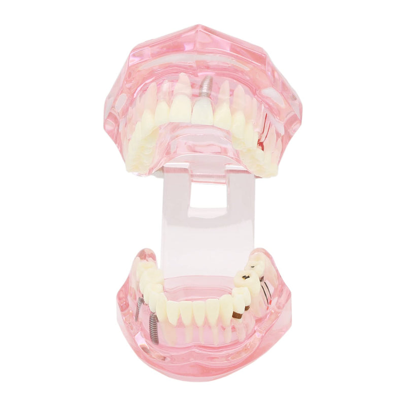 Teeth Model Teeth Typodonts Dental Implant Study Analysis Demonstration Teeth Model #2001 with Restoration Pink - BeesActive Australia