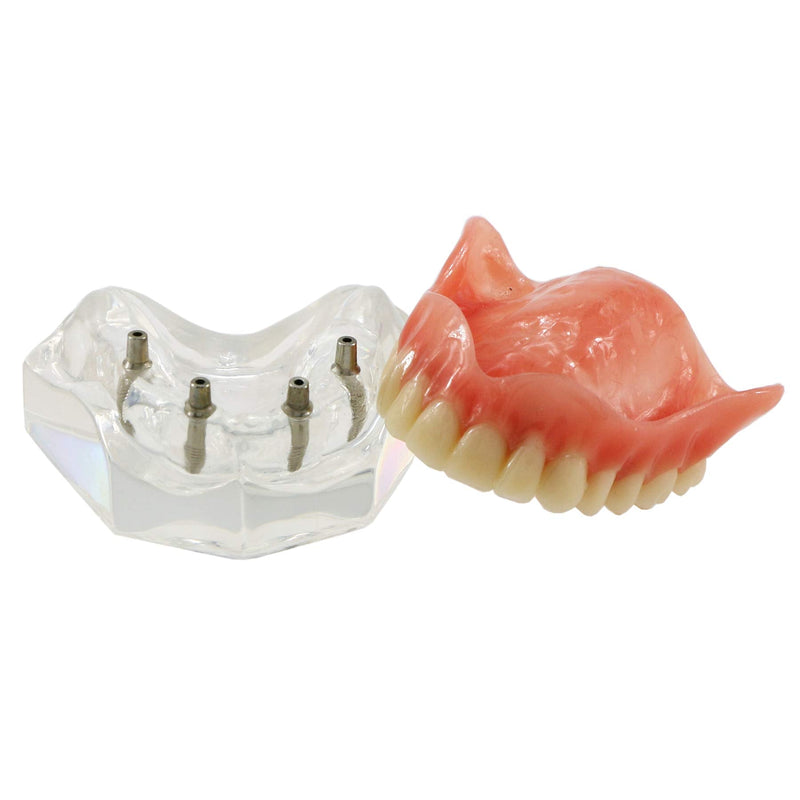 Dental Upper Implants Model Overdenture with 4 Superior Teeth Demo Transparent Vision for Education and Study Model Tool M6001 C