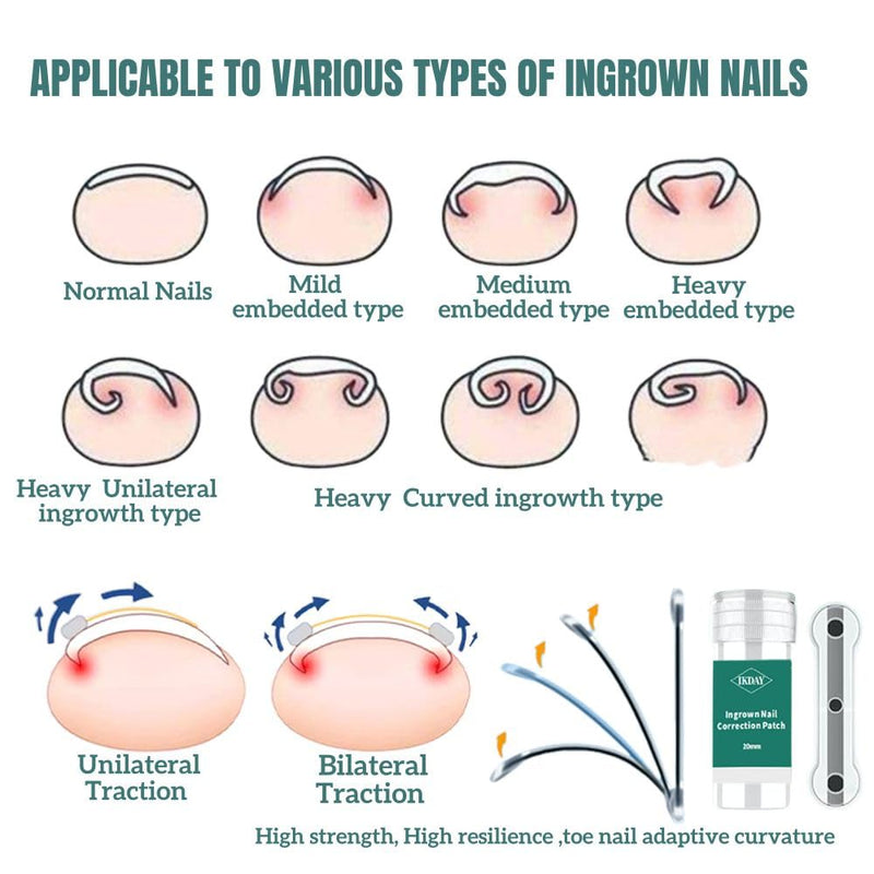 Ingrown Toenail Removal Kit | Titanium Alloy Ingrown Toenail Treatment | Pedicure Tools for Feet, Nail Tools Specially Designed for Curved Nail Repair and Ingrown Toenail Corrector (0.67/0.79in) 0.67/0.79in
