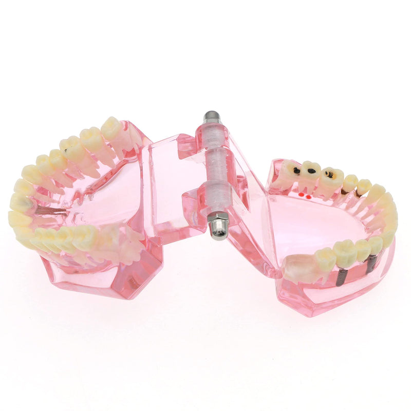 Teeth Model Teeth Typodonts Dental Implant Study Analysis Demonstration Teeth Model #2001 with Restoration Pink - BeesActive Australia