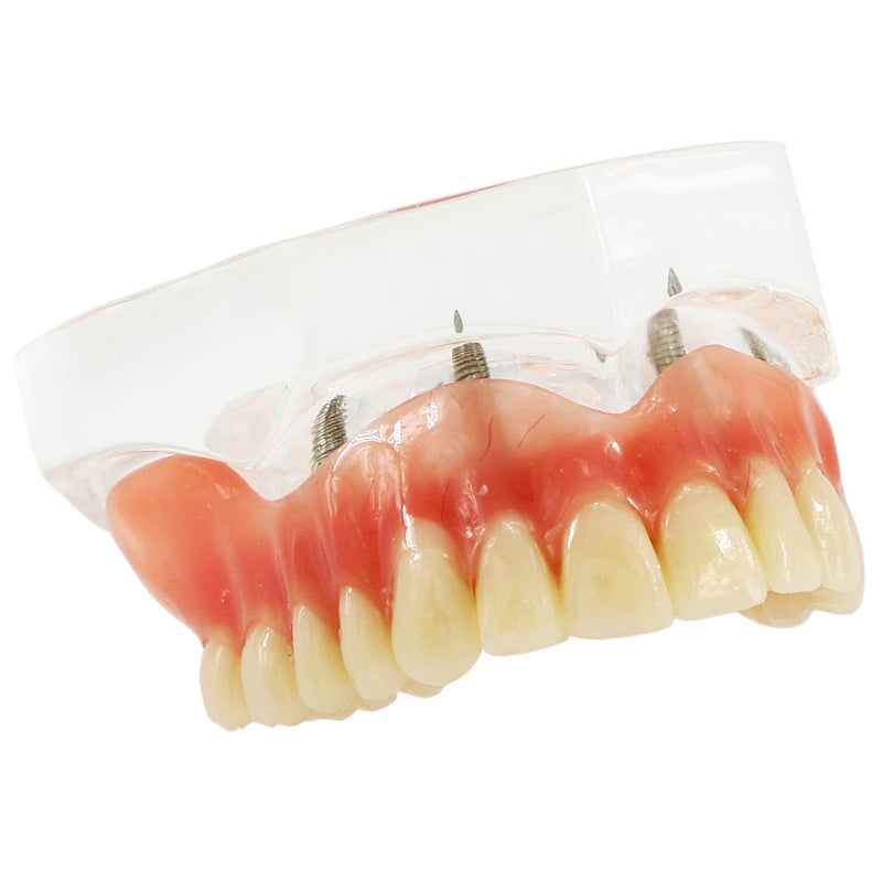 Dental Upper Implants Model Overdenture with 4 Superior Teeth Demo Transparent Vision for Education and Study Model Tool M6001 C
