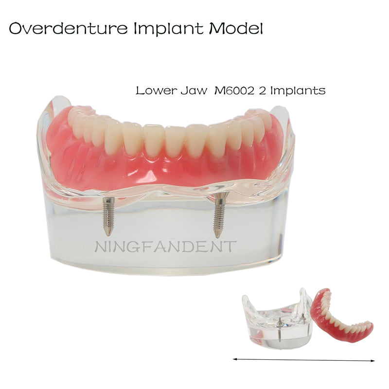 Dental Implant Model, Lower Jaw Overdenture, Removable Overdenture, with 2 Implants,M6002 M602