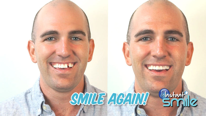 Instant Smile Complete Your Smile Temporary Tooth Replacement Kit - Replace a Missing Tooth in Minutes - Patented 40 Piece Assortment
