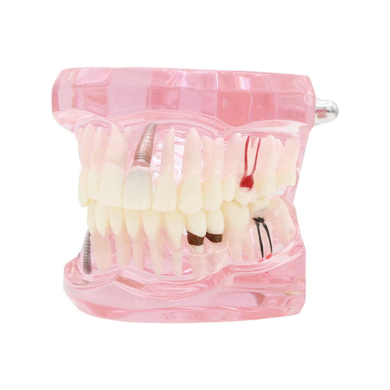 Teeth Model Teeth Typodonts Dental Implant Study Analysis Demonstration Teeth Model #2001 with Restoration Pink - BeesActive Australia