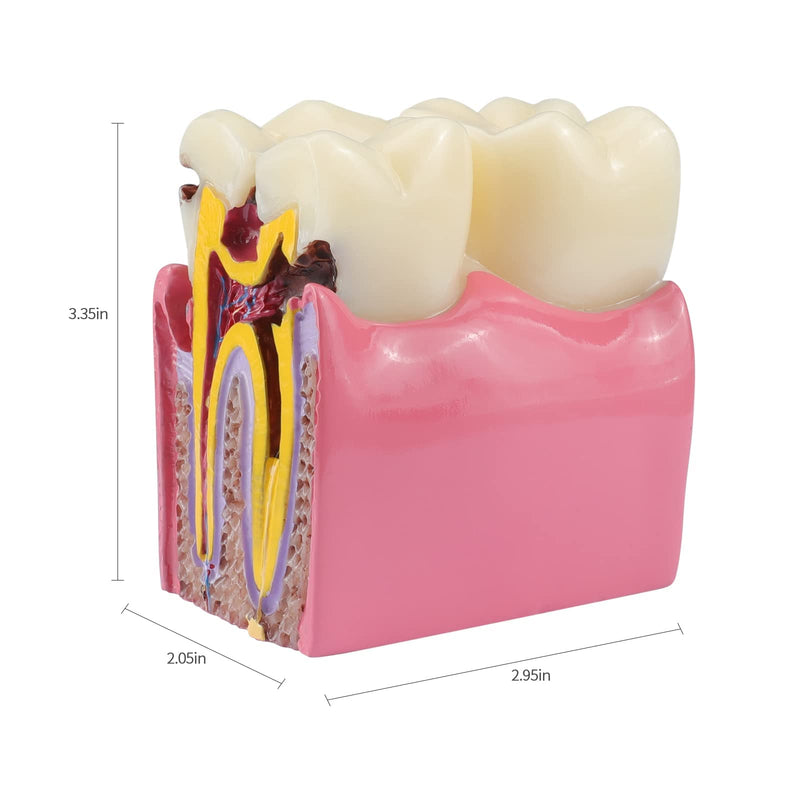 ANNWAH Dental Caries Teeth Model,Dental Anatomy Education Tooth Model,6 Times Caries Teaching Typodont Tool for Dentists, Patients, Teachers and Students - BeesActive Australia