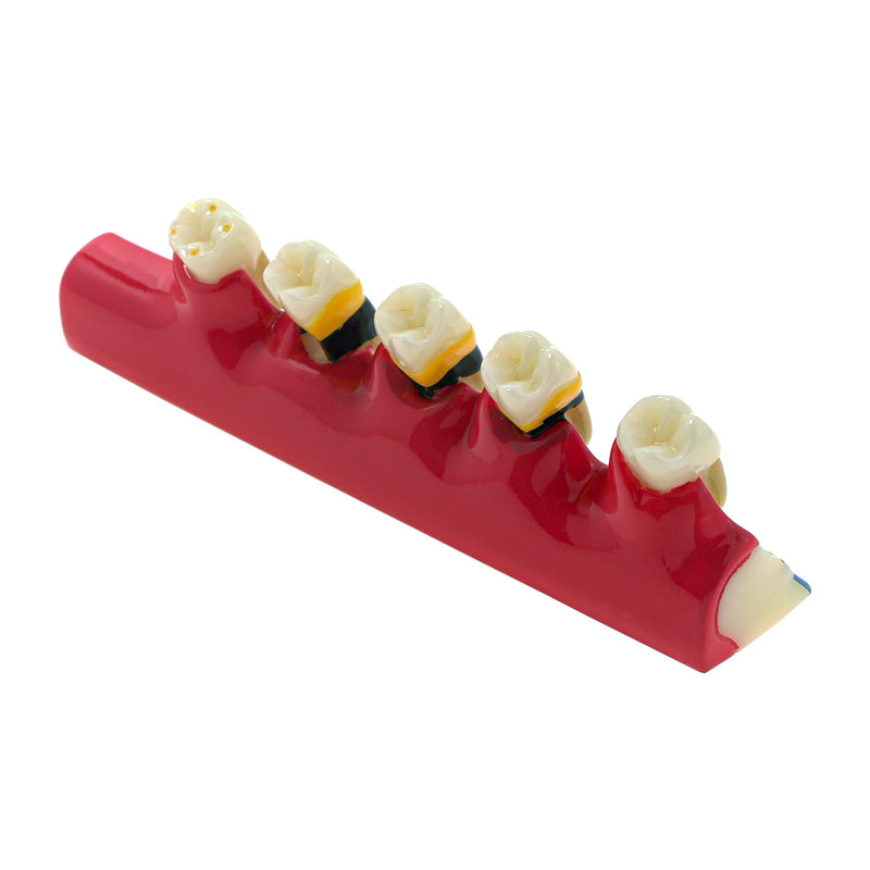 Dental Teeth Model 6-Stage Periodontal Disease Demonstration Model for Dental Education - BeesActive Australia