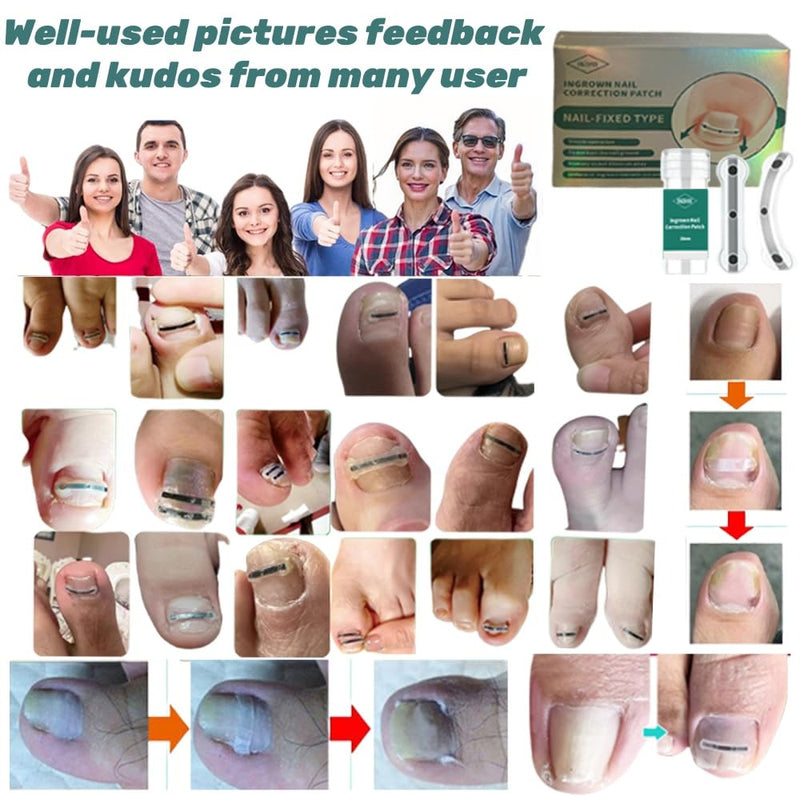 Ingrown Toenail Removal Kit | Titanium Alloy Ingrown Toenail Treatment | Pedicure Tools for Feet, Nail Tools Specially Designed for Curved Nail Repair and Ingrown Toenail Corrector (0.67/0.79in) 0.67/0.79in