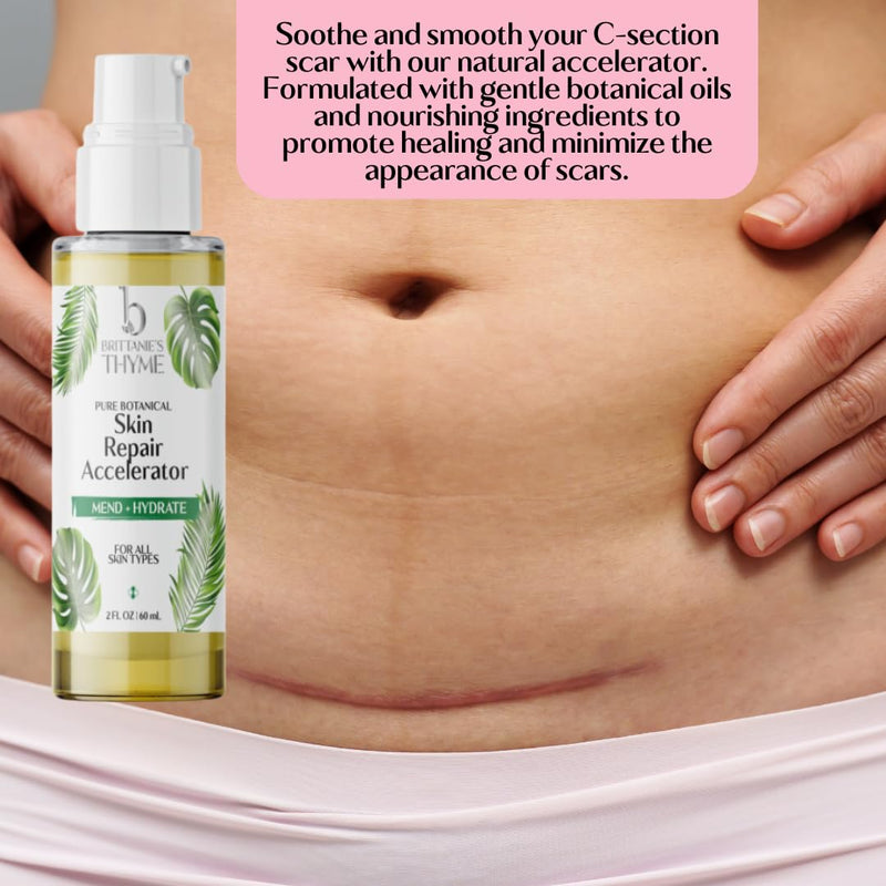 Brittanie's Skin & Scar Repair Accelerator For C Section Recovery, Scars, Stretchmarks & Tattoos | Natural, Non-Toxic Healing Treatment, Dermatologist Recommended, Deeply Nourishes, Reduces Wrinkles