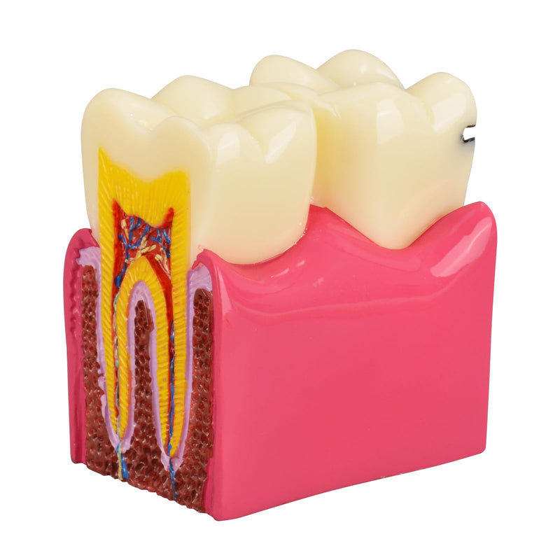 Ultrassist Dental Tooth Decay Model, Dental Caries Demonstration Model, Tooth Anatomy Teaching Model for Dental Education, Patient Explanation and Oral Health Classroom Teaching - BeesActive Australia