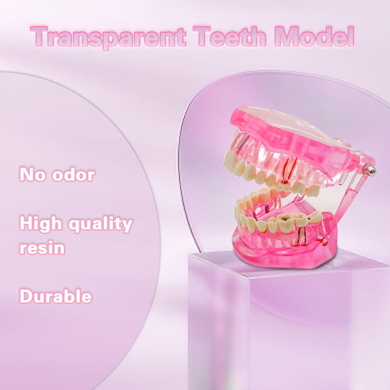 Transparent Disease Teeth Model with Dental Implant Bridge, Dental Teach Crown Bridge Removable Model, Tooth Model for Patient and Dental Student Education. (Red) Red - BeesActive Australia